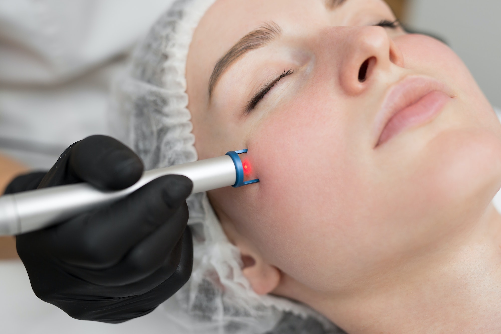 Close-up removal of blood vessels on the face of a diode laser in a cosmetic clinic. Therapist